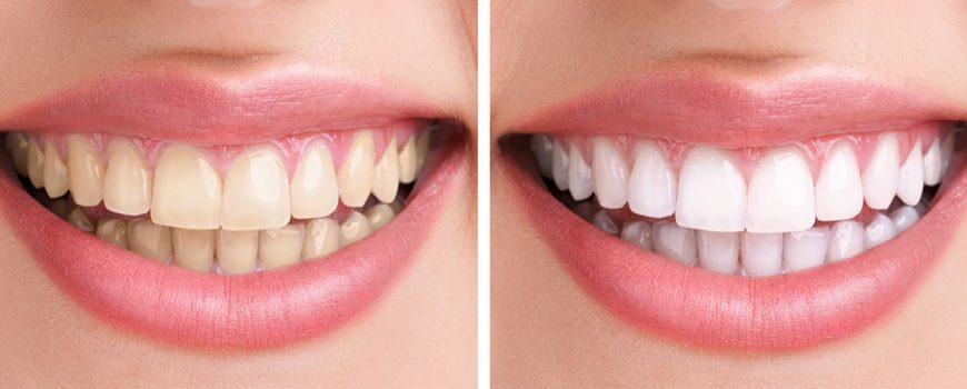 klironomou Teeth Whitening